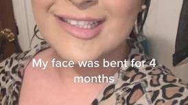 Mulher toma injeção para emagrecer e fica com o rosto desfigurado por meses