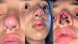 Jovem fica com nariz necrosado após procedimento estético