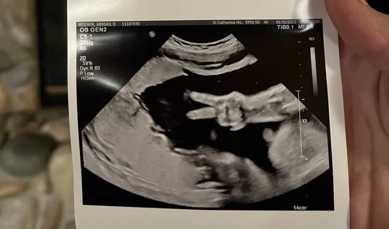 Gesto de bebê em foto de ultrassom pega pais de surpresa: ‘Nunca vimos nada assim antes’