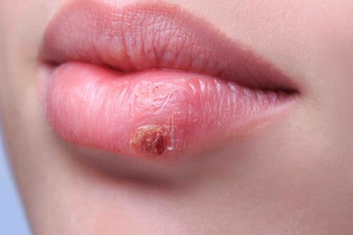 Principais causas para surgimento do herpes labial; como controlar