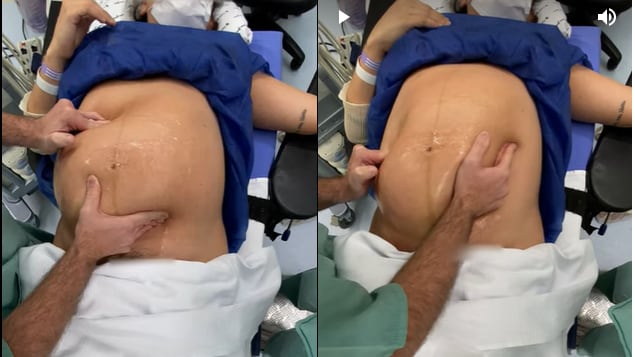 Vídeo impressionante mostra médico virando bebê na barriga da mãe antes do parto
