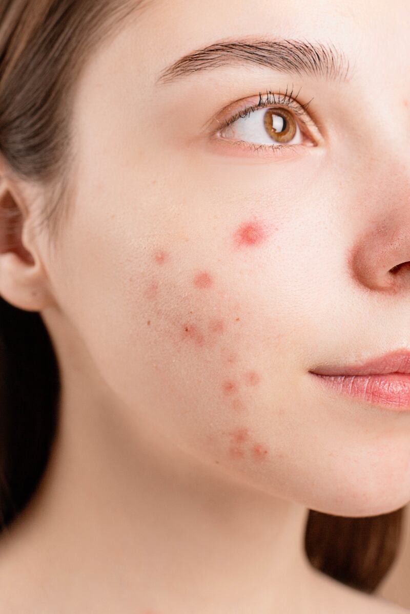 Mulher com acnes no rosto